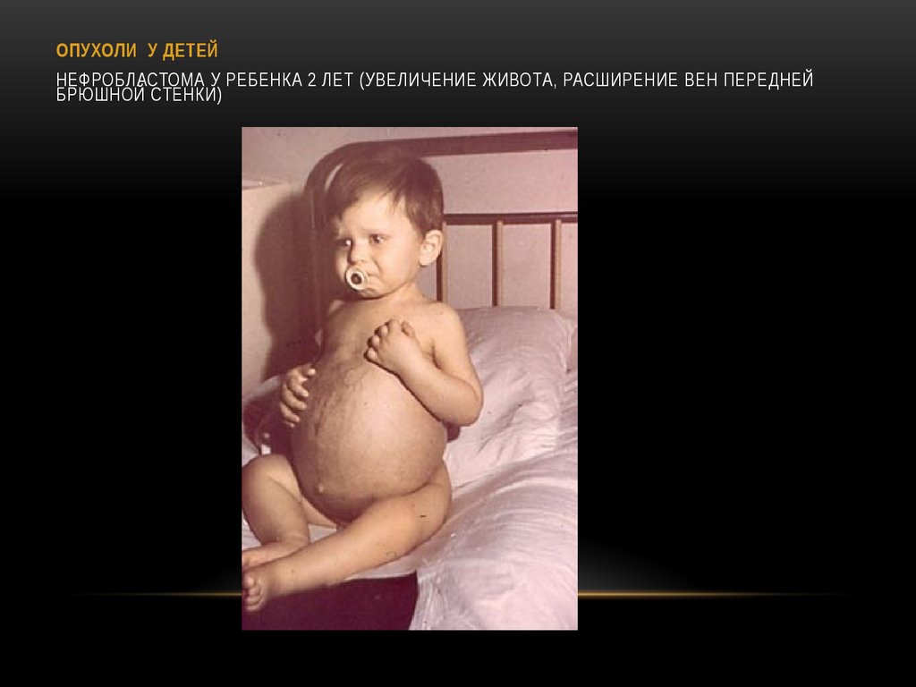 ОПУХОЛИ У ДЕТЕЙ Нефробластома у ребенка 2 лет (увеличение живота, расширение вен передней брюшной стенки)