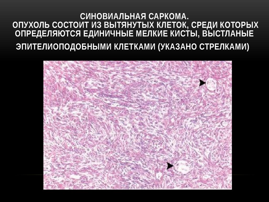 Синовиальная саркома. Опухоль состоит из вытянутых клеток, среди которых определяются единичные мелкие кисты, выстланые