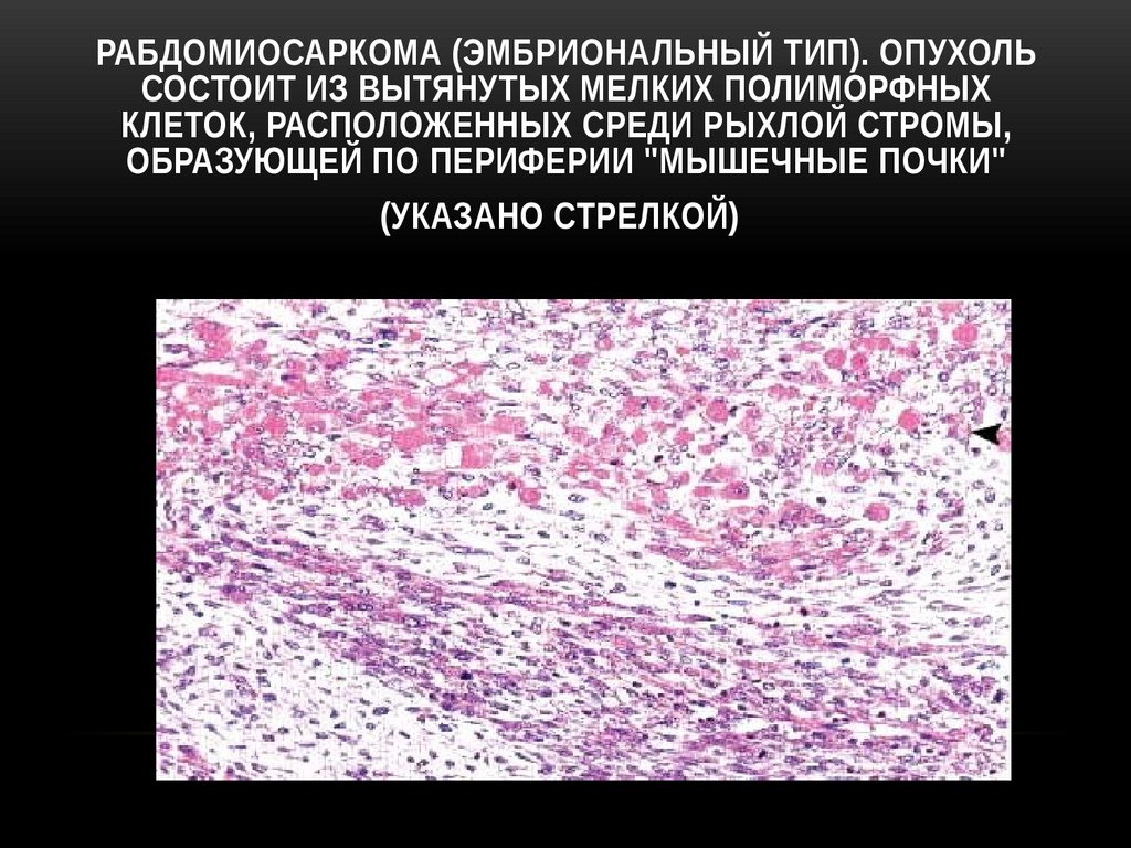 Рабдомиосаркома (эмбриональный тип). Опухоль состоит из вытянутых мелких полиморфных клеток, расположенных среди рыхлой стромы,