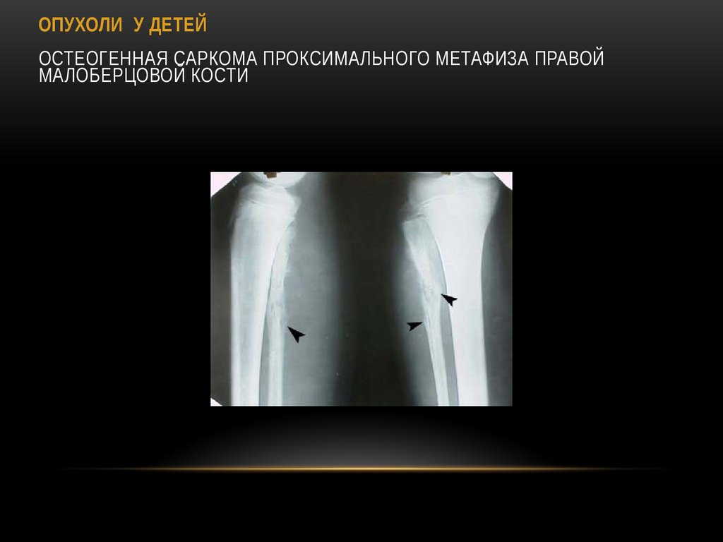 ОПУХОЛИ У ДЕТЕЙ Остеогенная саркома проксимального метафиза правой малоберцовой кости