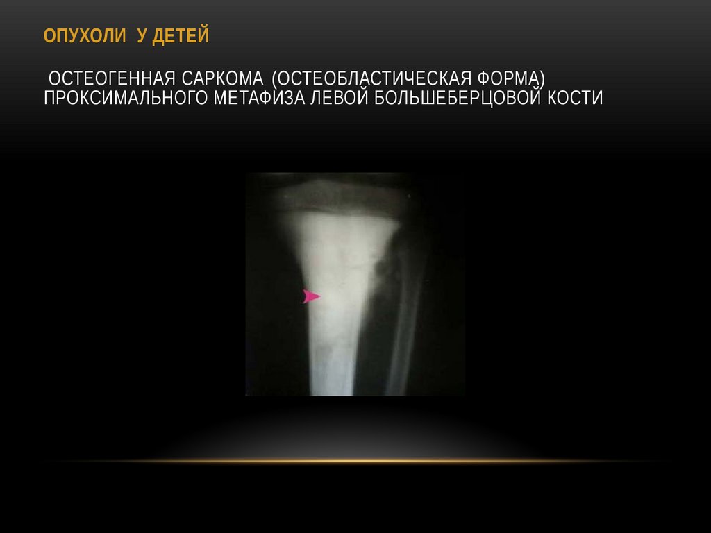 ОПУХОЛИ У ДЕТЕЙ Остеогенная саркома (остеобластическая форма) проксимального метафиза левой большеберцовой кости