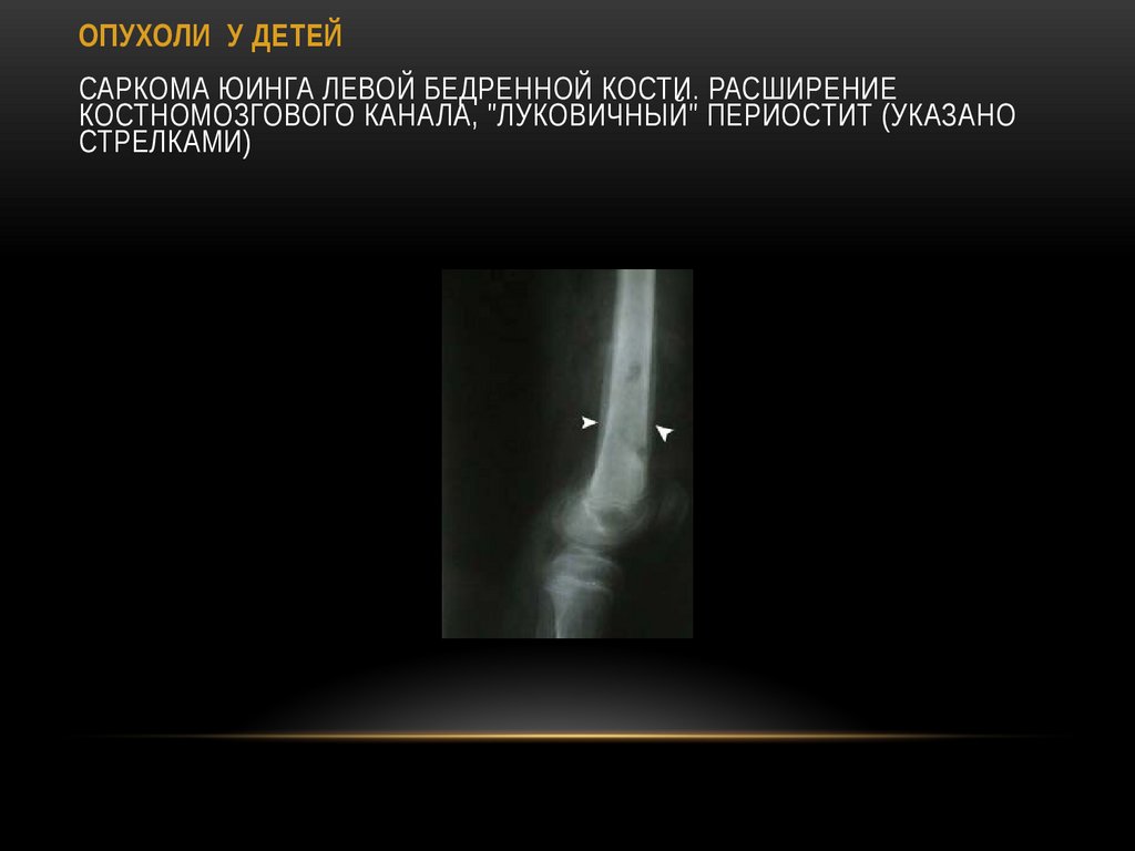 ОПУХОЛИ У ДЕТЕЙ Саркома Юинга левой бедренной кости. Расширение костномозгового канала, "луковичный" периостит (указано