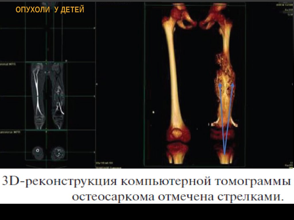 ОПУХОЛИ У ДЕТЕЙ
