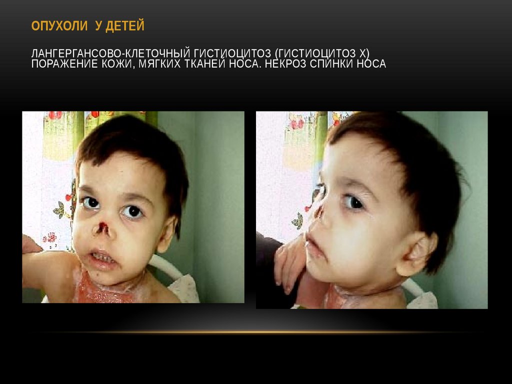 ОПУХОЛИ У ДЕТЕЙ Лангергансово-клеточный гистиоцитоз (гистиоцитоз Х) Поражение кожи, мягких тканей носа. Некроз спинки носа