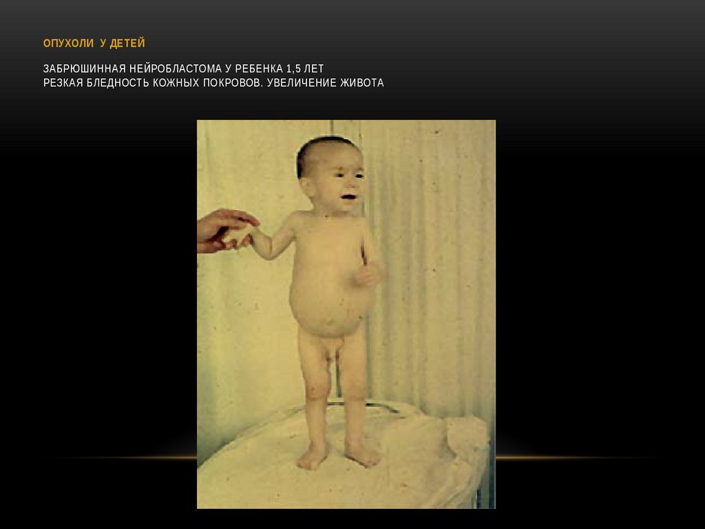 ОПУХОЛИ У ДЕТЕЙ Забрюшинная нейробластома у ребенка 1,5 лет Резкая бледность кожных покровов. Увеличение живота