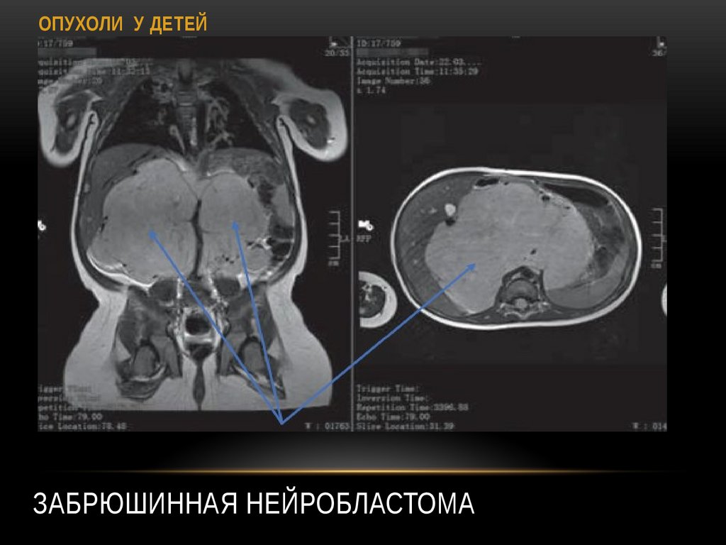 Забрюшинная нейробластома