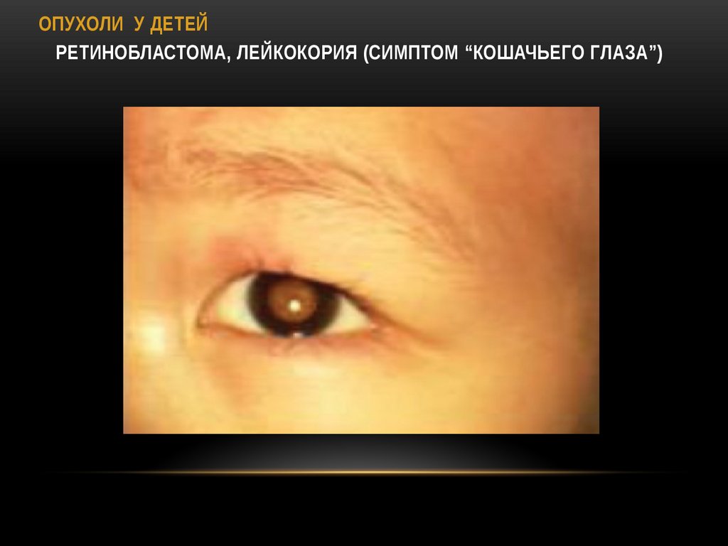 Ретинобластома, лейкокория (симптом “кошачьего глаза”)