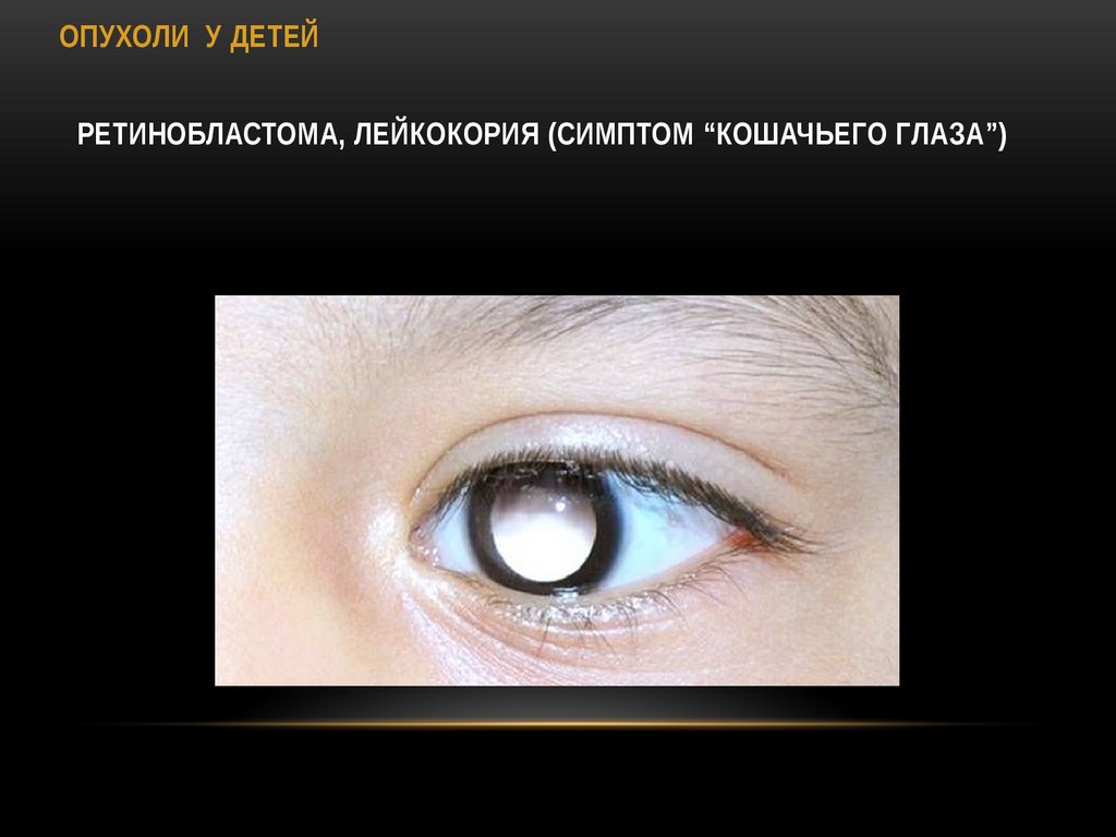 Ретинобластома, лейкокория (симптом “кошачьего глаза”)