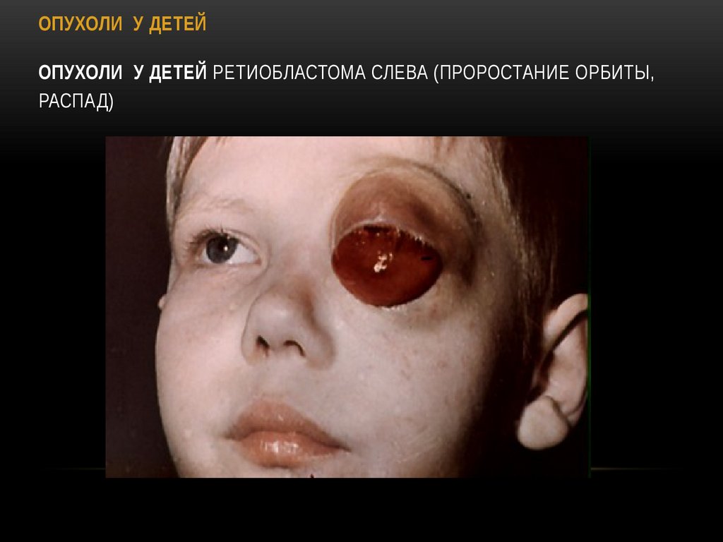 ОПУХОЛИ У ДЕТЕЙ Ретиобластома слева (проростание орбиты, распад)