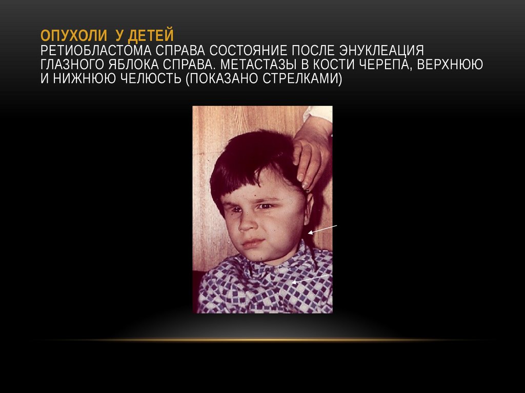 ОПУХОЛИ У ДЕТЕЙ Ретиобластома справа Состояние после энуклеация глазного яблока справа. Метастазы в кости черепа, верхнюю и