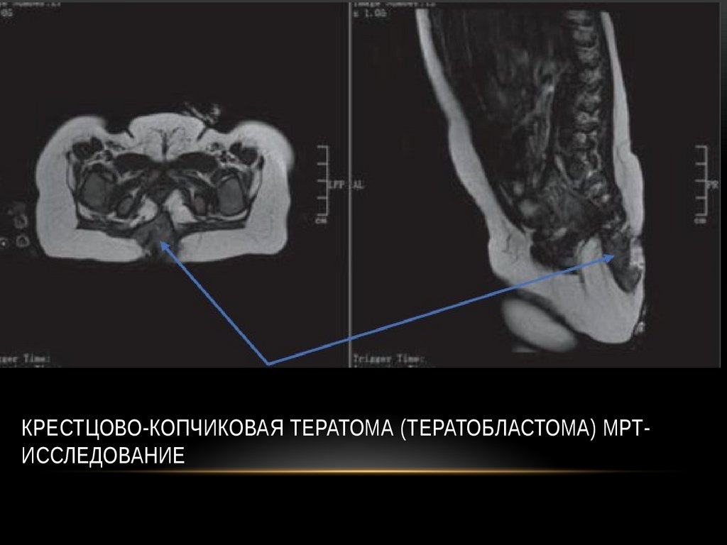 Крестцово-копчиковая тератома (тератобластома) МРТ- исследование