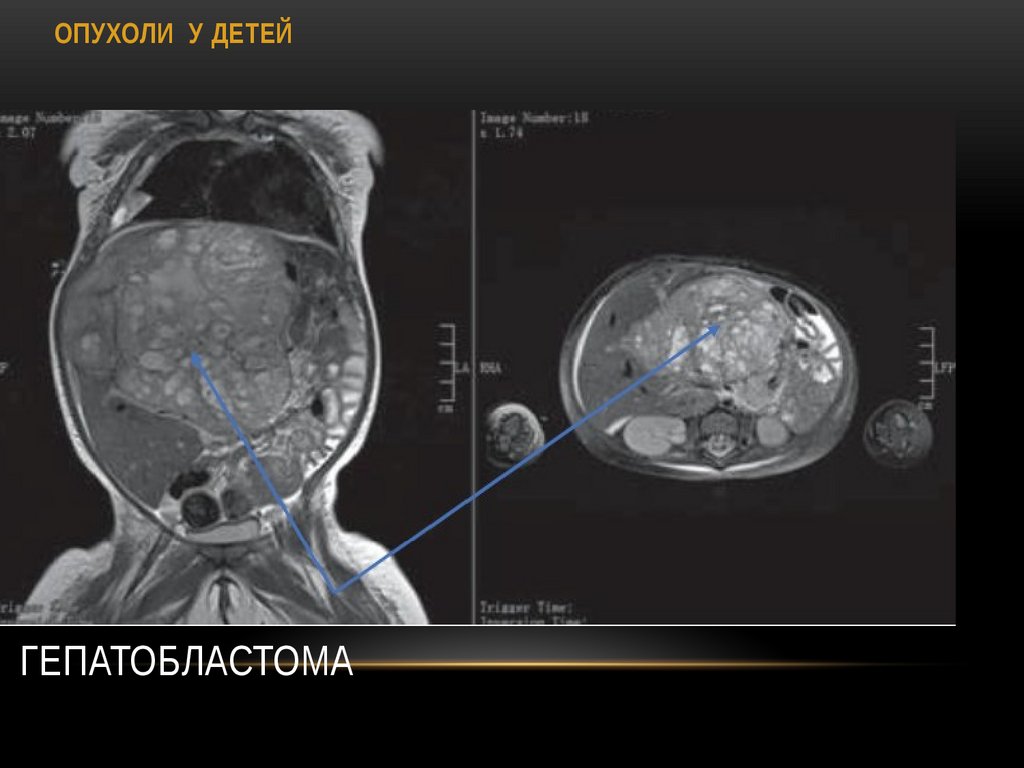 Гепатобластома