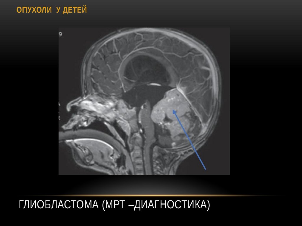 Глиобластома (МРТ –диагностика)
