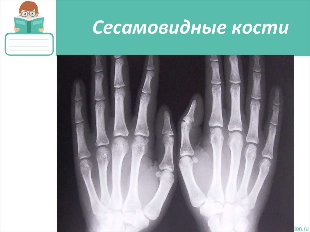 Сесамовидные кости