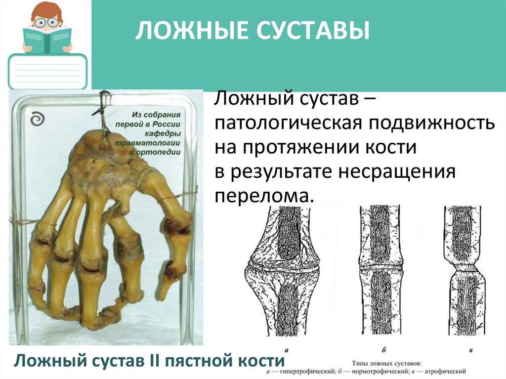 ЛОЖНЫЕ СУСТАВЫ