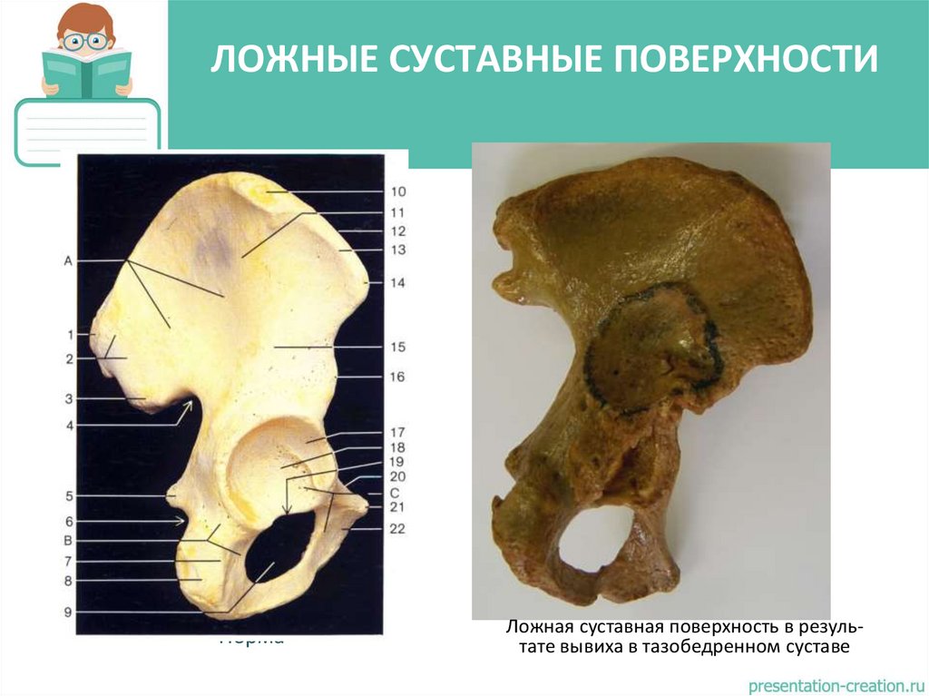ЛОЖНЫЕ СУСТАВНЫЕ ПОВЕРХНОСТИ