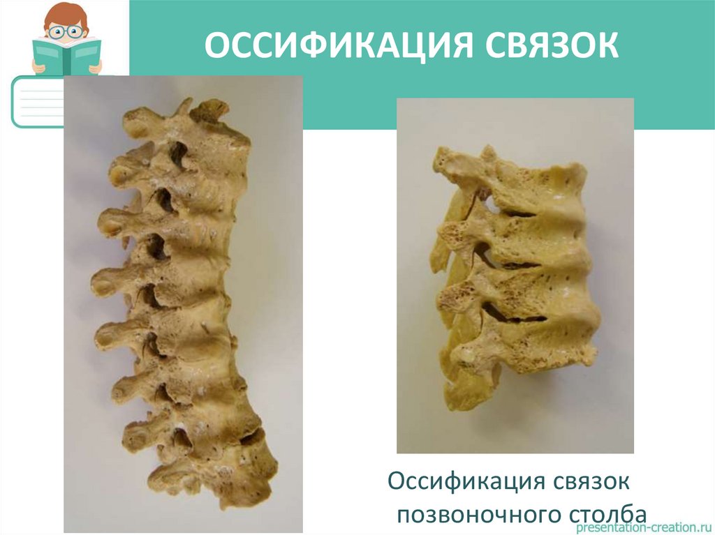 ОССИФИКАЦИЯ СВЯЗОК