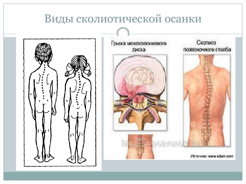Виды сколиотической осанки