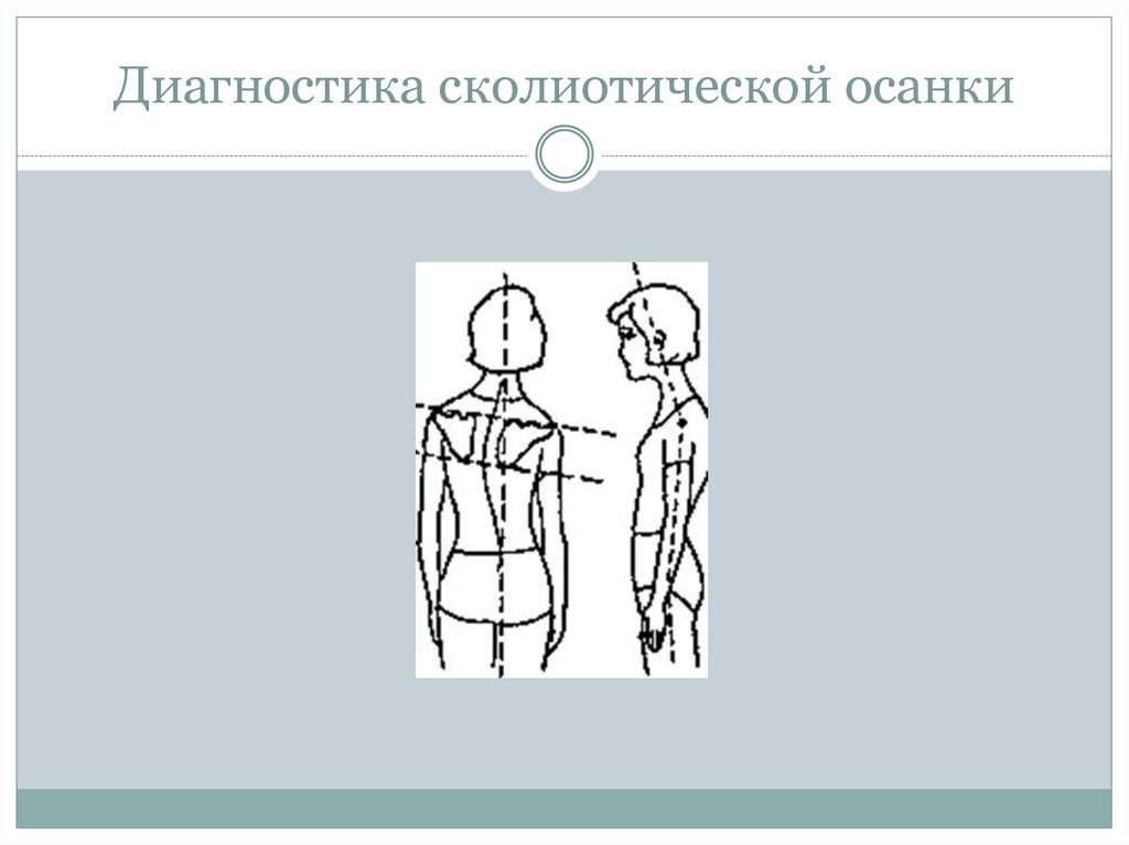 Диагностика сколиотической осанки