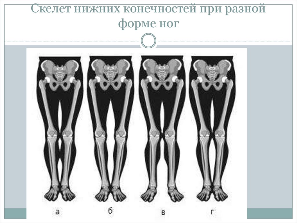 Скелет нижних конечностей при разной форме ног