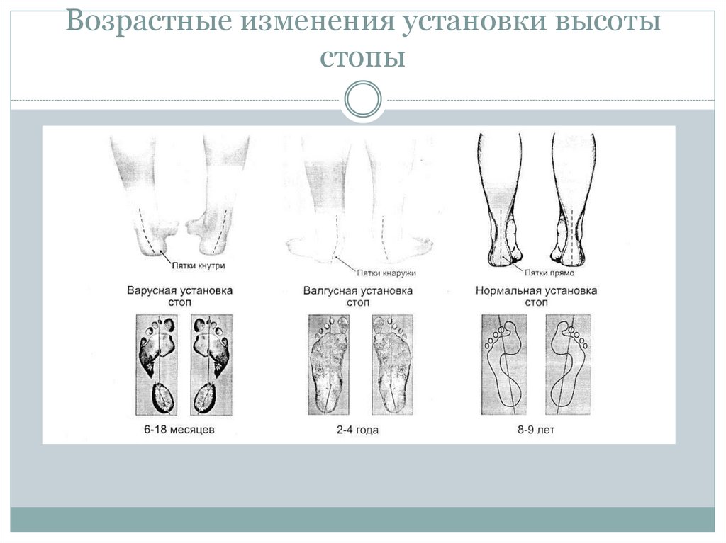 Возрастные изменения установки высоты стопы