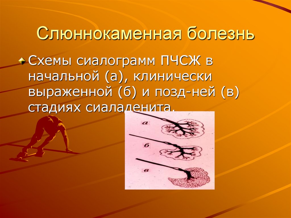 Слюннокаменная болезнь