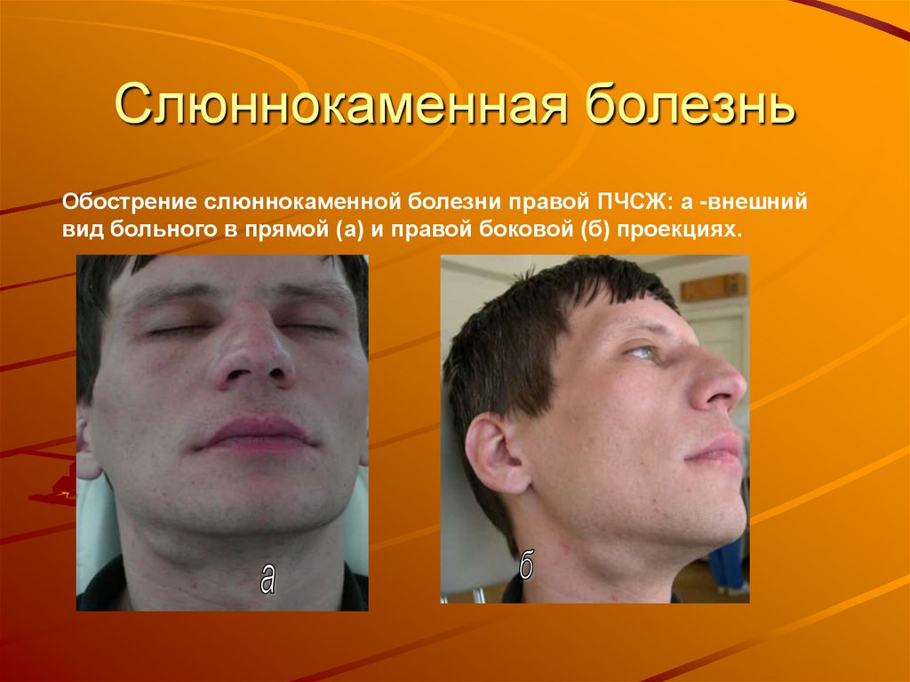 Слюннокаменная болезнь