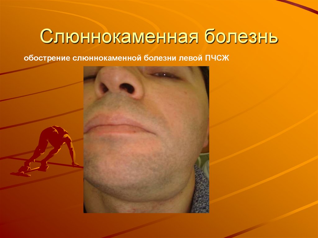 Слюннокаменная болезнь