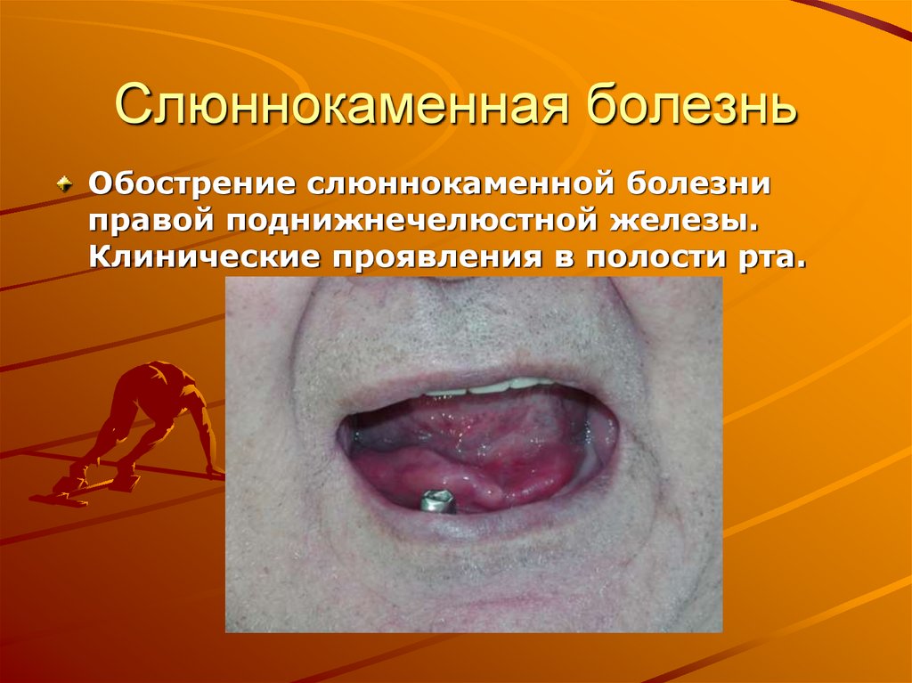 Слюннокаменная болезнь