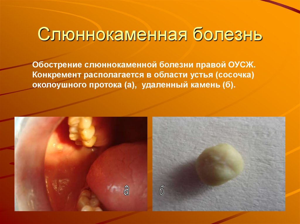 Слюннокаменная болезнь