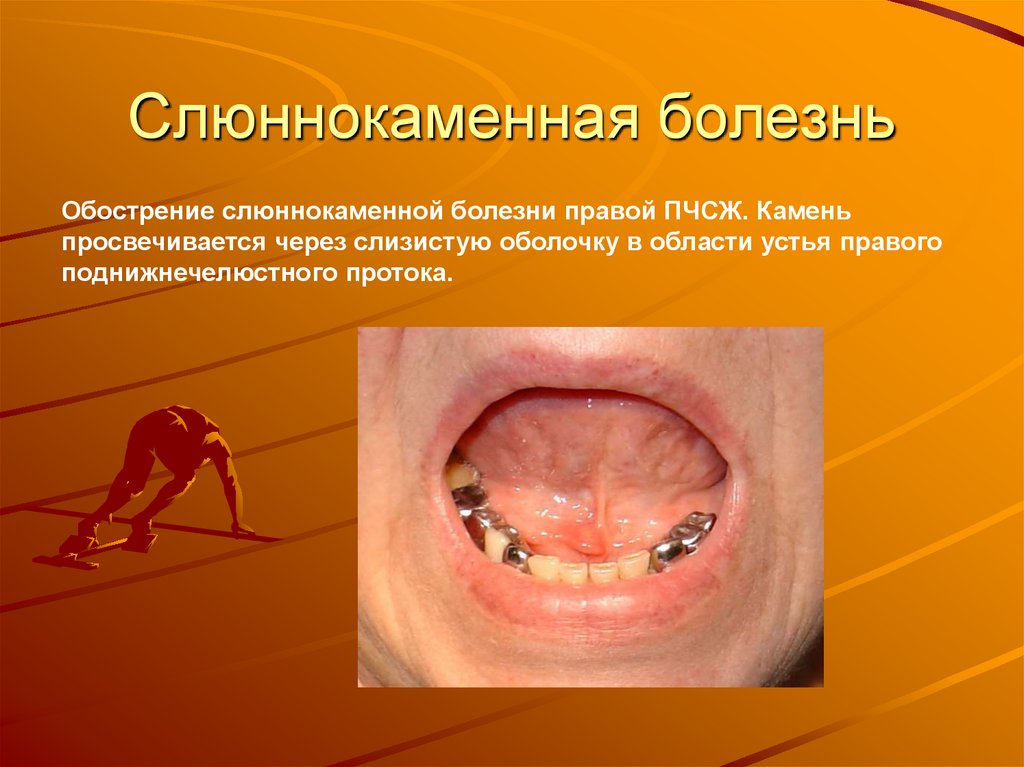 Слюннокаменная болезнь