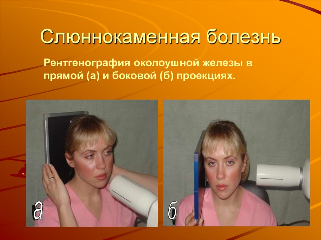 Слюннокаменная болезнь