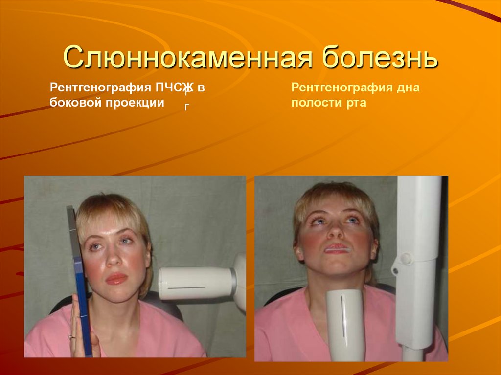 Слюннокаменная болезнь