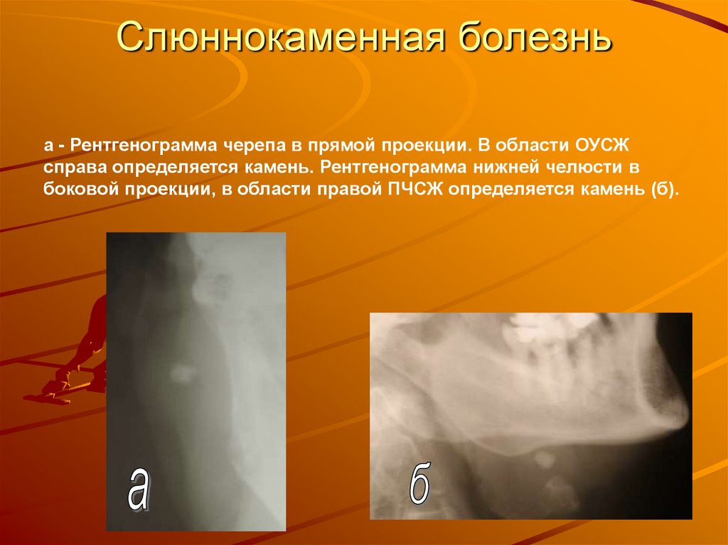 Слюннокаменная болезнь