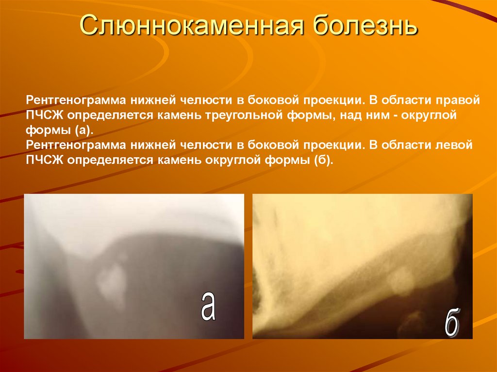 Слюннокаменная болезнь