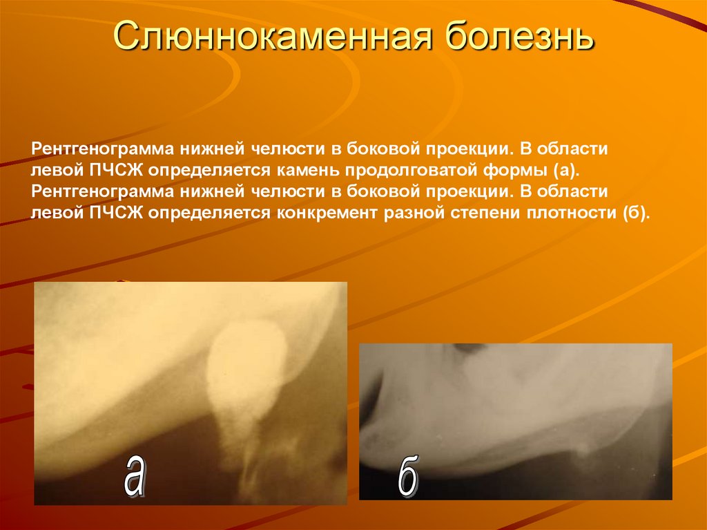 Слюннокаменная болезнь