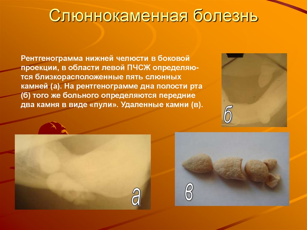 Слюннокаменная болезнь