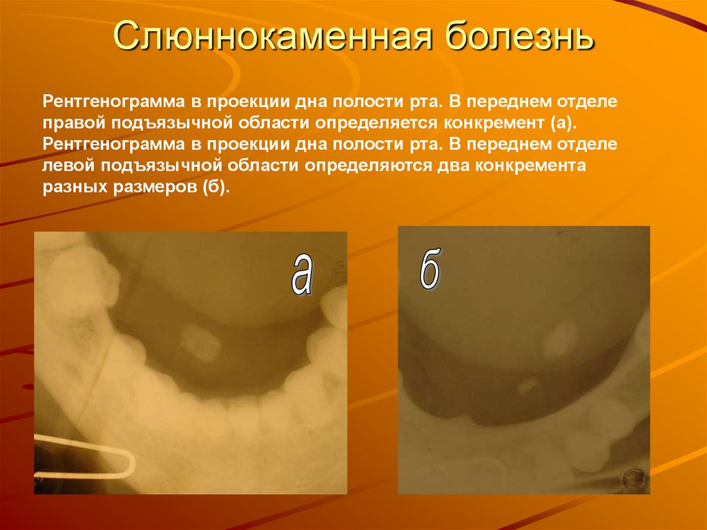 Слюннокаменная болезнь