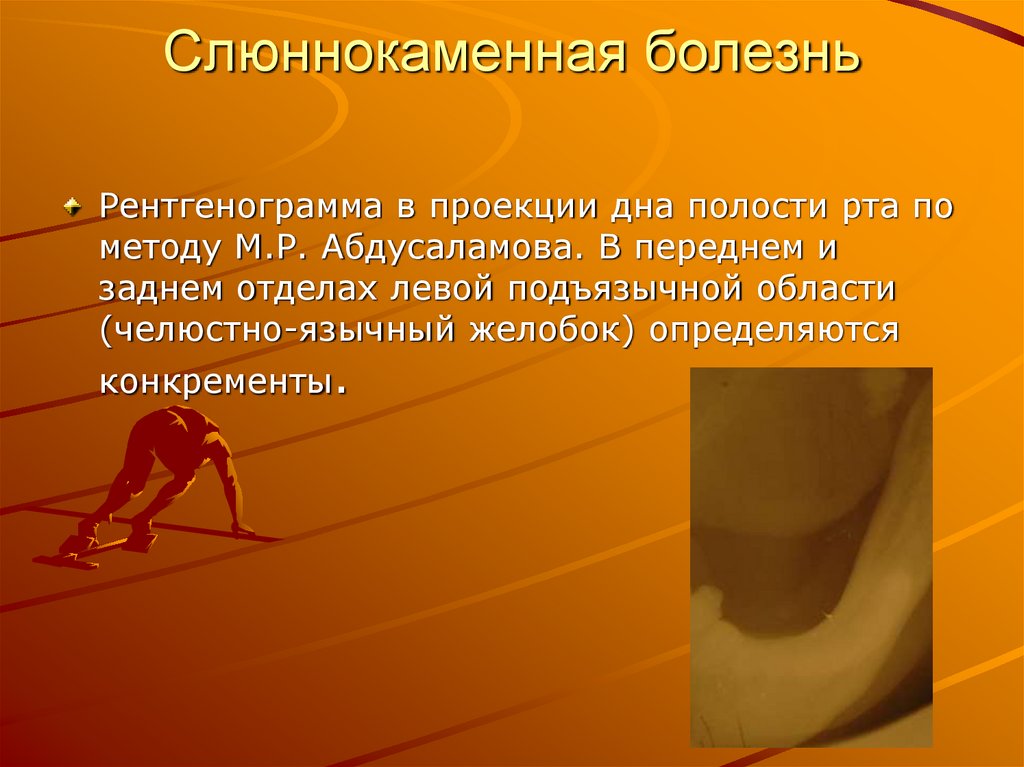 Слюннокаменная болезнь