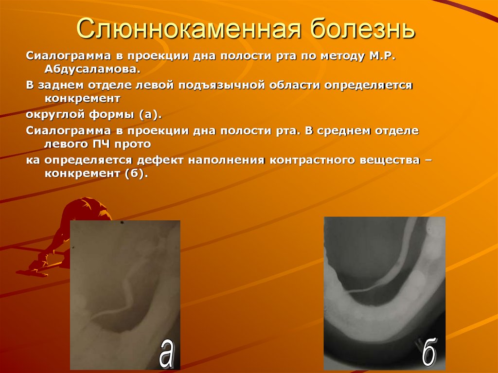 Слюннокаменная болезнь