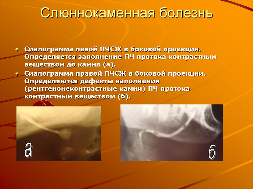 Слюннокаменная болезнь