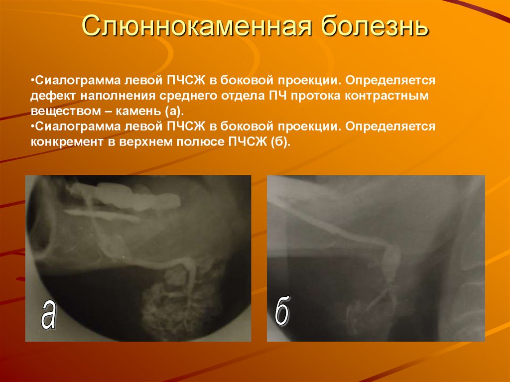 Слюннокаменная болезнь