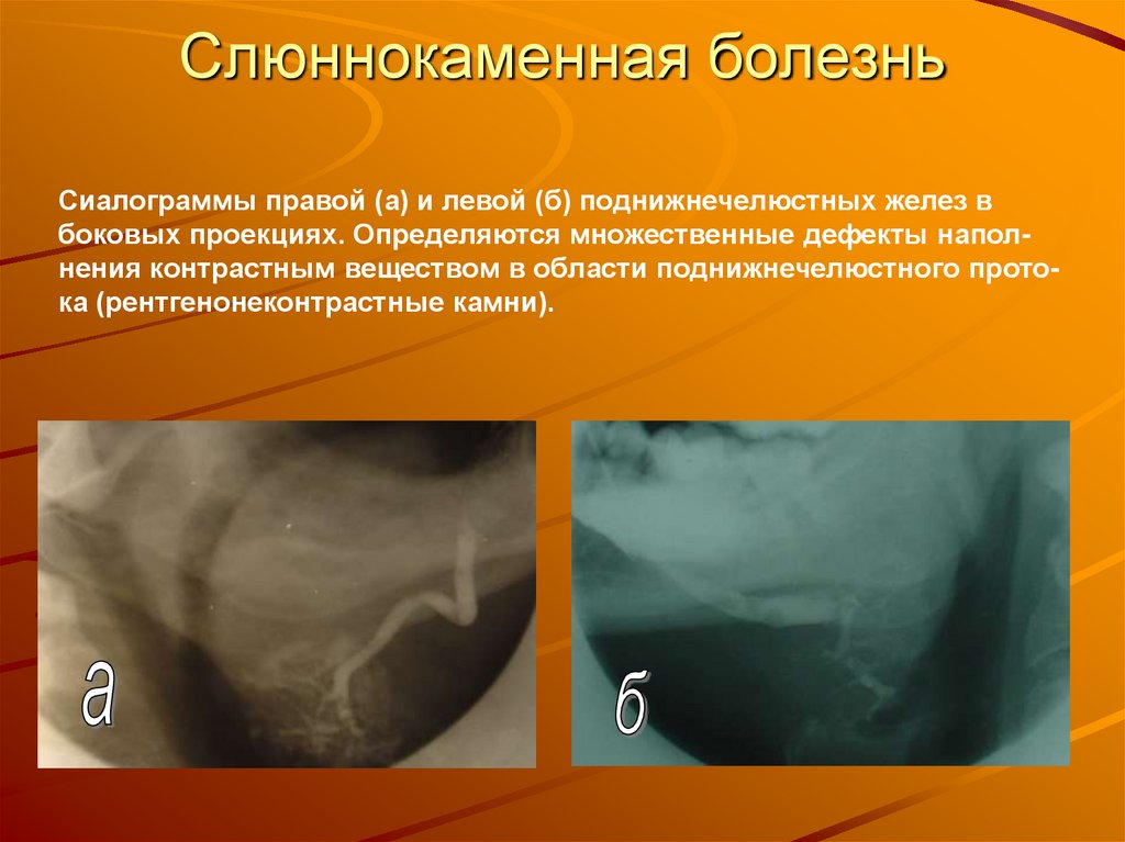 Слюннокаменная болезнь