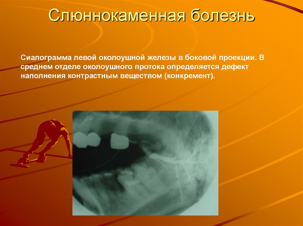 Слюннокаменная болезнь