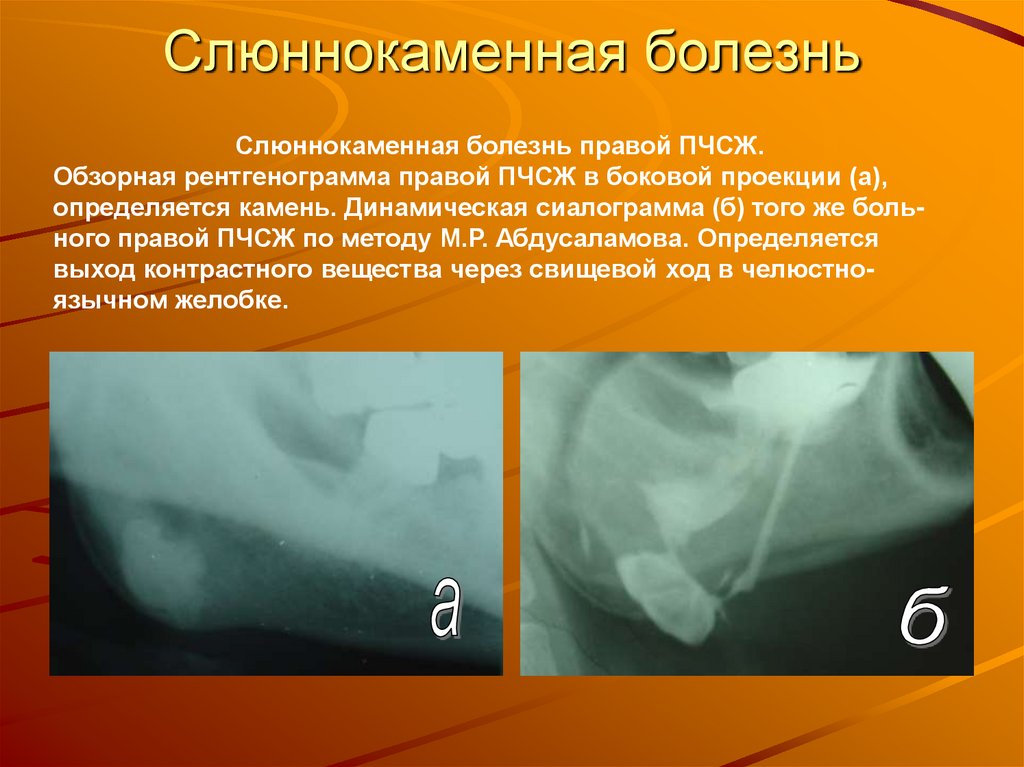 Слюннокаменная болезнь