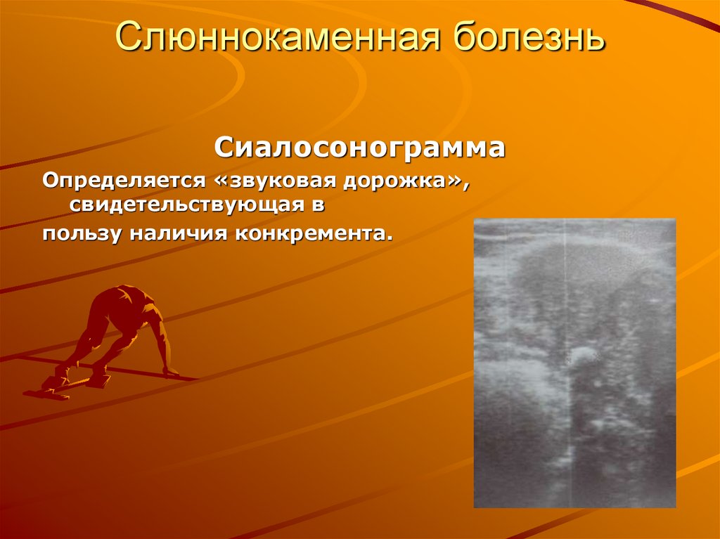 Слюннокаменная болезнь