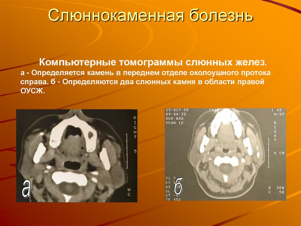 Слюннокаменная болезнь