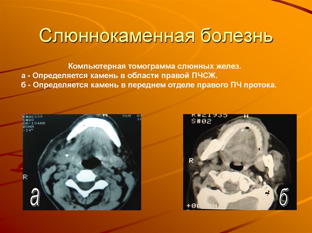 Слюннокаменная болезнь