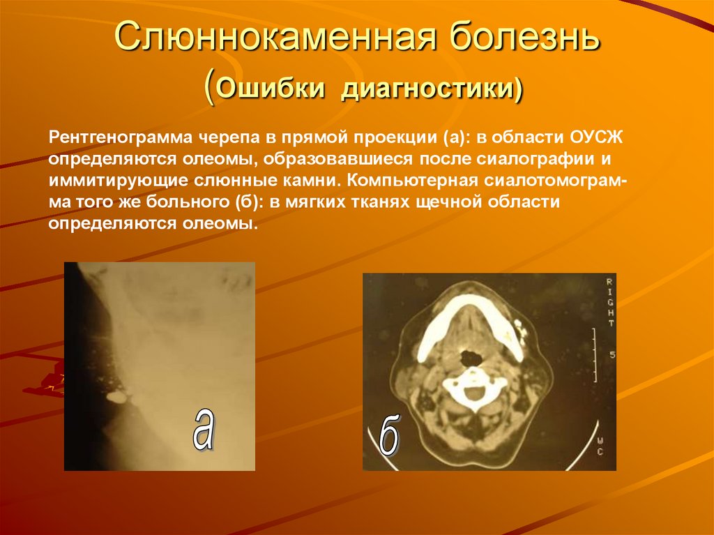 Слюннокаменная болезнь (Ошибки диагностики)