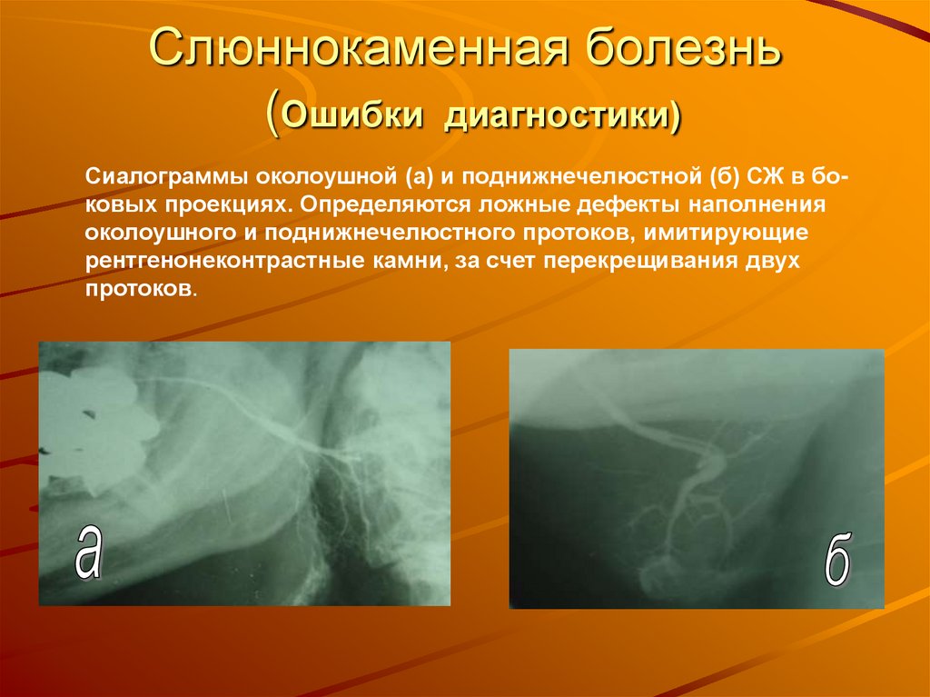 Слюннокаменная болезнь (Ошибки диагностики)